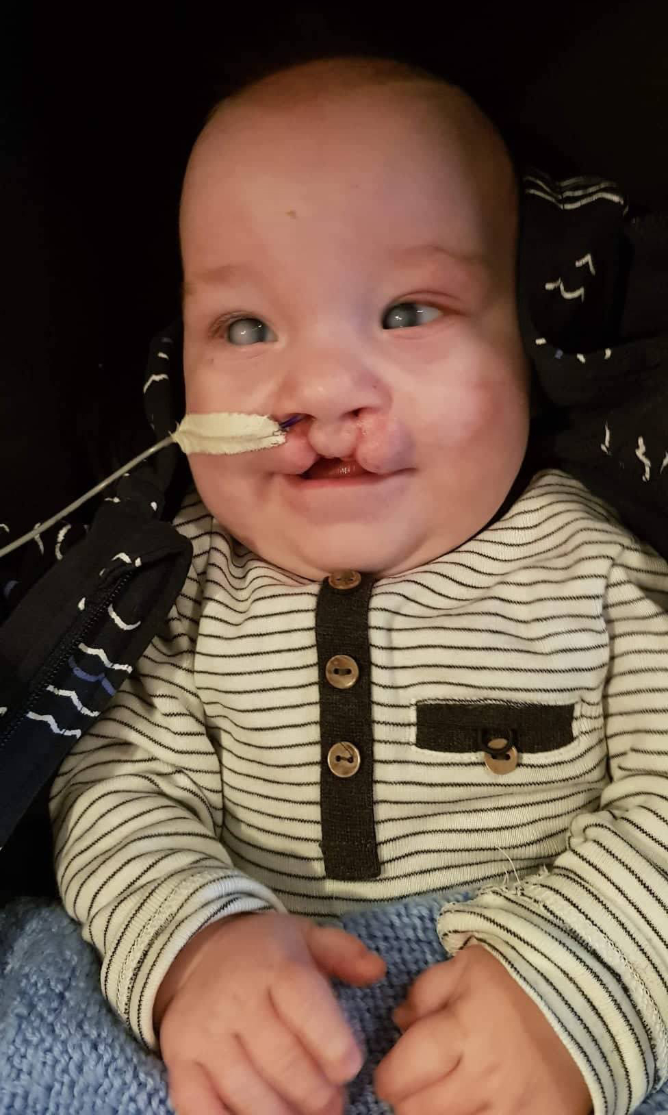 Eini Íslendingurinn sem greinst hefur með Peters-plus syndrome – þarf í aðgerðir til Pittsburg Eini Íslendingurinn sem greinst hefur með Peters-plus syndrome – þarf í aðgerðir til Pittsburg